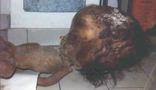 CriancaHIDROCEFALIA