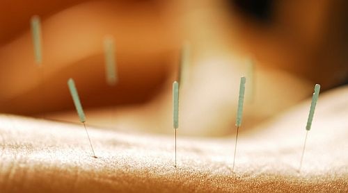 acupunturaocidental
